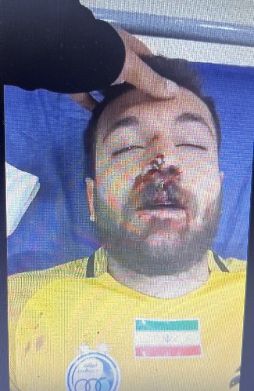 عکس دروازه بان استقلالی در اتاق عمل بسیار شدید بود/مصدومیت!